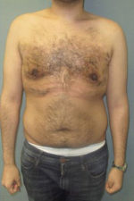 Severe Gynecomastia