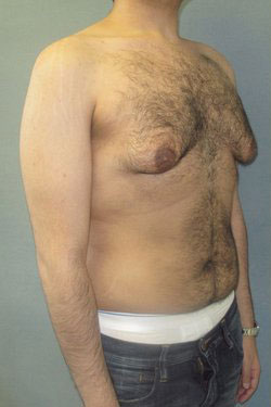 Severe Gynecomastia