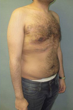 Severe Gynecomastia