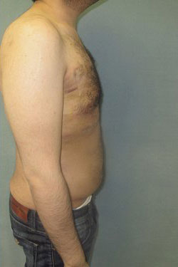 Severe Gynecomastia