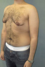 Severe Gynecomastia