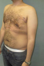 Severe Gynecomastia