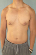 Severe Gynecomastia