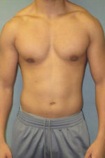 Severe Gynecomastia