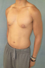 Severe Gynecomastia