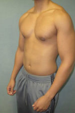 Severe Gynecomastia