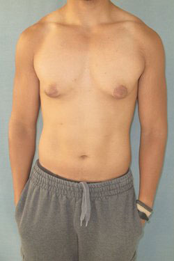 Severe Gynecomastia