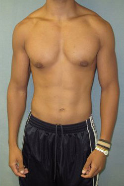 Severe Gynecomastia