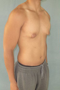 Severe Gynecomastia