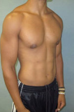 Severe Gynecomastia