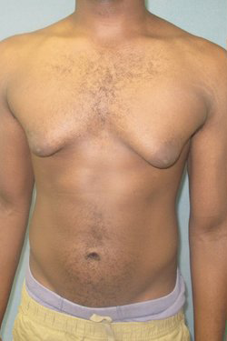 Severe Gynecomastia