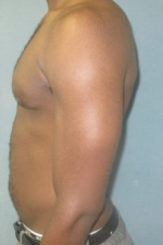 Severe Gynecomastia