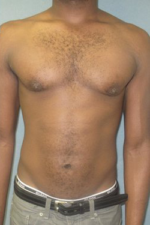 Severe Gynecomastia