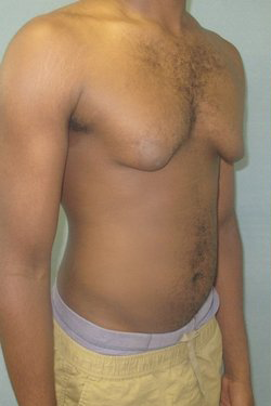 Severe Gynecomastia