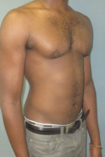 Severe Gynecomastia