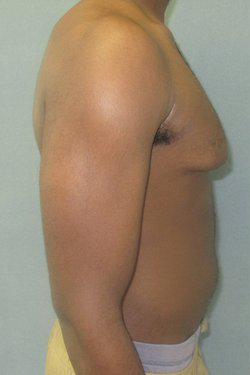 Severe Gynecomastia