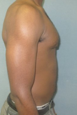 Severe Gynecomastia