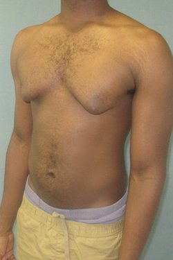 Severe Gynecomastia