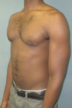 Severe Gynecomastia