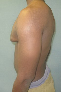 Severe Gynecomastia