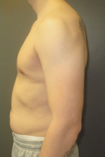 Severe Gynecomastia