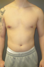 Severe Gynecomastia