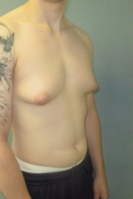 Severe Gynecomastia