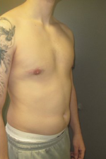 Severe Gynecomastia