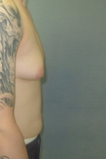 Severe Gynecomastia