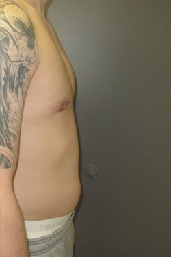 Severe Gynecomastia