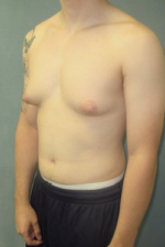 Severe Gynecomastia