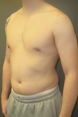 Severe Gynecomastia