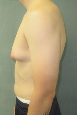 Severe Gynecomastia