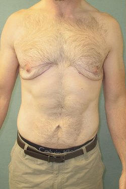 Severe Gynecomastia