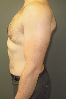 Severe Gynecomastia