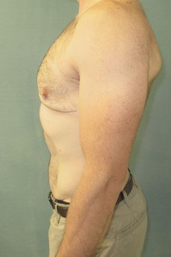 Severe Gynecomastia