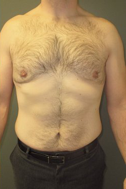 Severe Gynecomastia