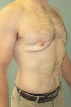 Severe Gynecomastia