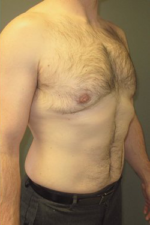 Severe Gynecomastia