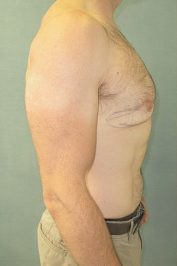 Severe Gynecomastia