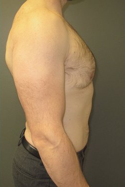 Severe Gynecomastia