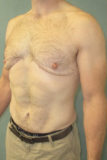 Severe Gynecomastia