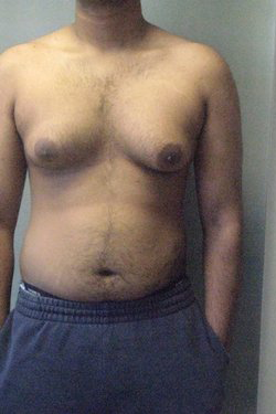 Severe Gynecomastia