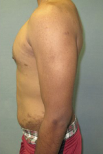 Severe Gynecomastia