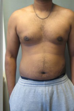 Severe Gynecomastia