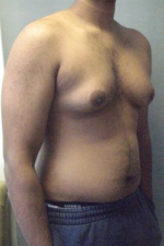 Severe Gynecomastia