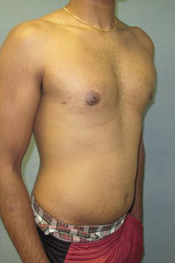 Severe Gynecomastia