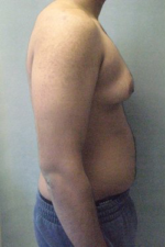 Severe Gynecomastia