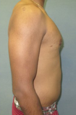 Severe Gynecomastia