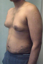 Severe Gynecomastia